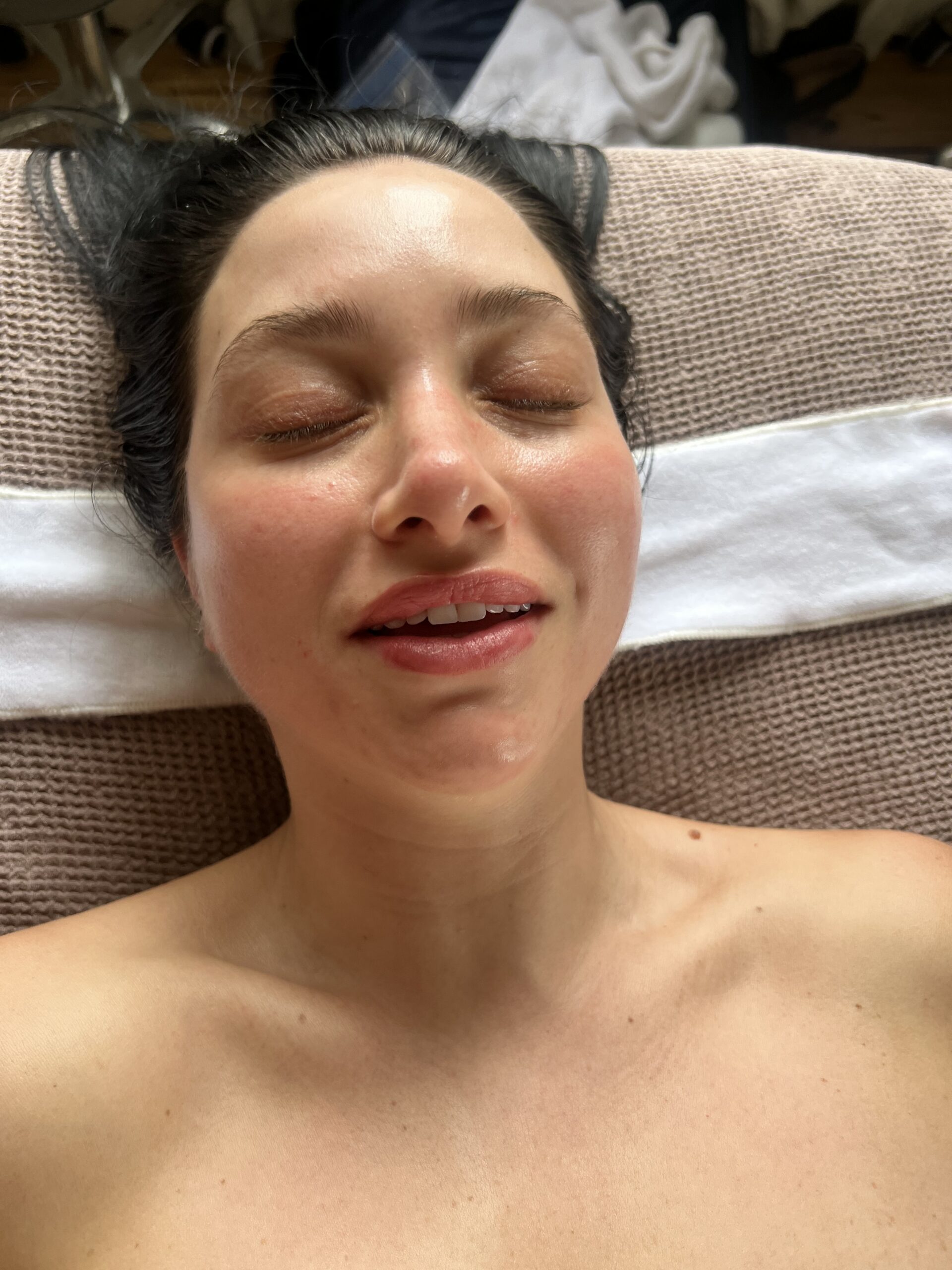 after dermaplane service with my skin by michelle